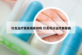 针灸治疗银屑病有效吗 针灸可以治疗银屑病