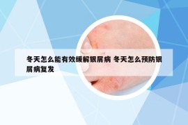 冬天怎么能有效缓解银屑病 冬天怎么预防银屑病复发