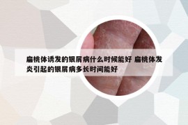 扁桃体诱发的银屑病什么时候能好 扁桃体发炎引起的银屑病多长时间能好