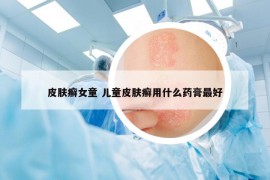 皮肤癣女童 儿童皮肤癣用什么药膏最好