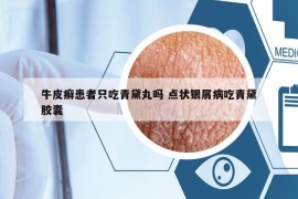 牛皮癣患者只吃青黛丸吗 点状银屑病吃青黛胶囊