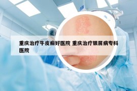 重庆治疗牛皮癣好医院 重庆治疗银屑病专科医院