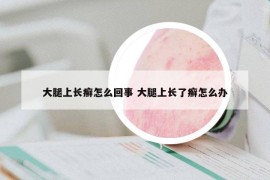 大腿上长癣怎么回事 大腿上长了癣怎么办