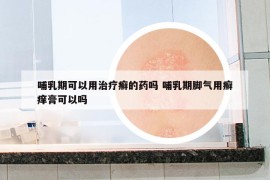 哺乳期可以用治疗癣的药吗 哺乳期脚气用癣痒膏可以吗