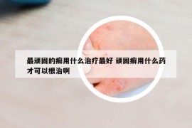 最顽固的癣用什么治疗最好 顽固癣用什么药才可以根治啊