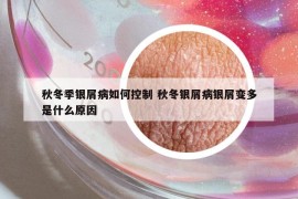 秋冬季银屑病如何控制 秋冬银屑病银屑变多是什么原因