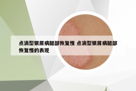 点滴型银屑病腿部恢复慢 点滴型银屑病腿部恢复慢的表现