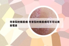 寻常型的银屑病 寻常型的银屑病可不可以用青霉素