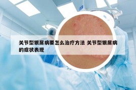 关节型银屑病要怎么治疗方法 关节型银屑病的症状表现