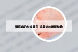 银屑病的辩证分型 银屑病的辨证论治