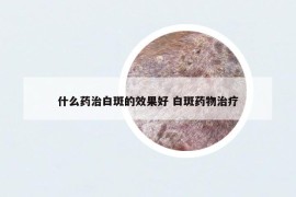 什么药治白斑的效果好 白斑药物治疗