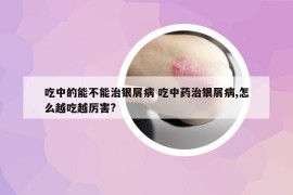 吃中的能不能治银屑病 吃中药治银屑病,怎么越吃越厉害?