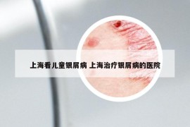 上海看儿童银屑病 上海治疗银屑病的医院