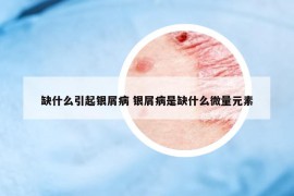 缺什么引起银屑病 银屑病是缺什么微量元素