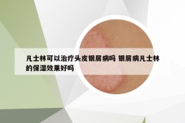 凡士林可以治疗头皮银屑病吗 银屑病凡士林的保湿效果好吗