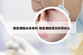 银屑病输水有用吗 银屑病输液会好得快么