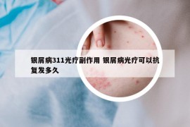 银屑病311光疗副作用 银屑病光疗可以抗复发多久