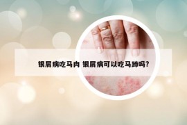 银屑病吃马肉 银屑病可以吃马蹄吗?