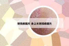 铜钱癣图片 身上长铜钱癣图片