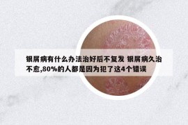 银屑病有什么办法治好后不复发 银屑病久治不愈,80%的人都是因为犯了这4个错误