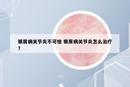 银屑病关节炎不可怕 银屑病关节炎怎么治疗?