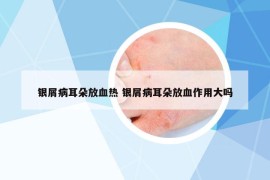 银屑病耳朵放血热 银屑病耳朵放血作用大吗