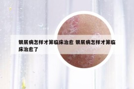 银屑病怎样才算临床治愈 银屑病怎样才算临床治愈了