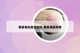 银屑病会尿潜血吗 银屑病尿常规