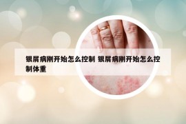 银屑病刚开始怎么控制 银屑病刚开始怎么控制体重