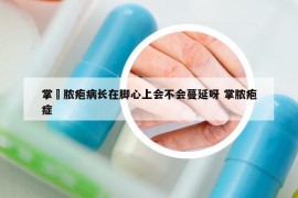 掌砋脓疱病长在脚心上会不会蔓延呀 掌脓疱症