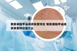 银屑病指甲油滴状损害特征 银屑病指甲油滴状损害特征是什么