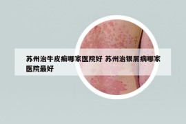 苏州治牛皮癣哪家医院好 苏州治银屑病哪家医院最好