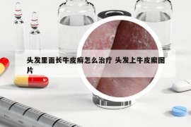 头发里面长牛皮癣怎么治疗 头发上牛皮廨图片