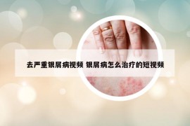 去严重银屑病视频 银屑病怎么治疗的短视频