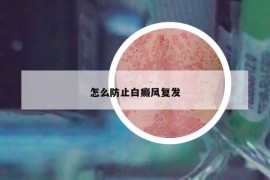 怎么防止白癜风复发