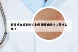 银屑病会长到脖子上吗 银屑病脖子上是什么样子