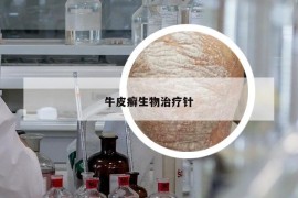 牛皮癣生物治疗针