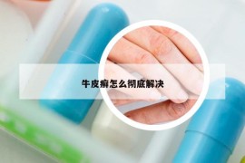 牛皮癣怎么彻底解决