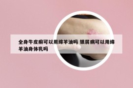 全身牛皮癣可以用绵羊油吗 银屑病可以用绵羊油身体乳吗