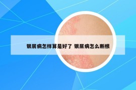 银屑病怎样算是好了 银屑病怎么断根