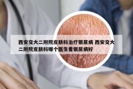 西安交大二附院皮肤科治疗银屑病 西安交大二附院皮肤科哪个医生看银屑病好