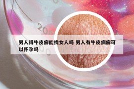 男人得牛皮癣能找女人吗 男人有牛皮病癣可以怀孕吗