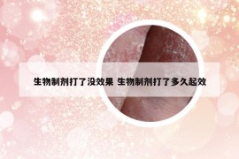 生物制剂打了没效果 生物制剂打了多久起效