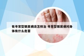 有寻常型银屑病该怎样治 寻常型银屑病对身体有什么危害