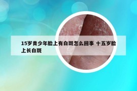 15岁青少年脸上有白斑怎么回事 十五岁脸上长白斑