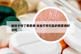 被蚊子咬了银屑病 蚊虫叮咬引起的银屑病好治吗