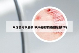 甲床萎缩银屑病 甲床萎缩银屑病能治好吗