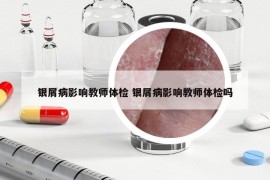 银屑病影响教师体检 银屑病影响教师体检吗