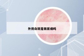 外阴白斑是银屑病吗