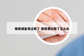 银屑病染发过敏了 银屑病过敏了怎么办